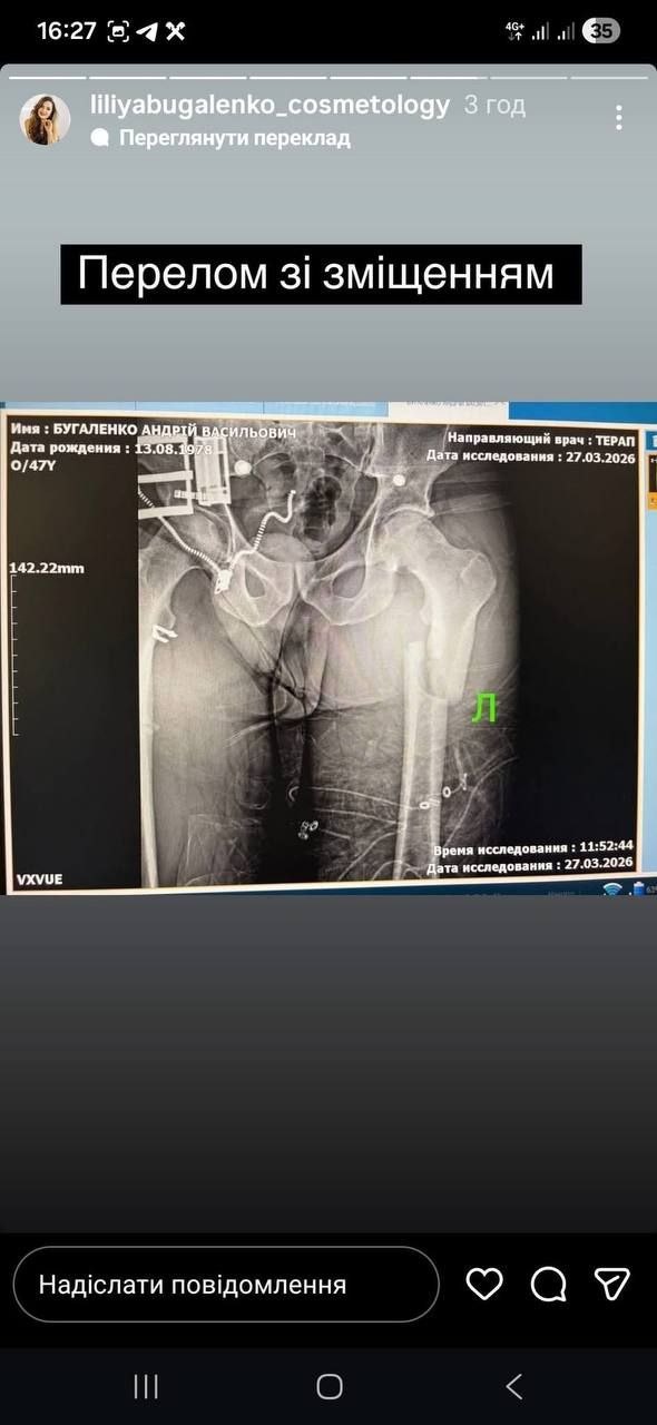 Фото рентгеновского снимка бедренной кости. Источник – Телеграм